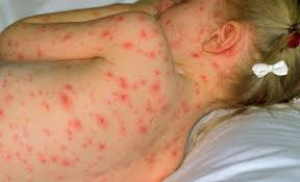 IMSS Bienestar Hidalgo realiza acciones preventivas ante alerta epidemiológica por sarampión