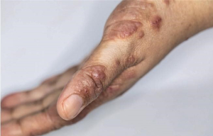 Emprende SSH campa&ntilde;a informativa sobre la escabiosis