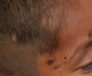 Recomienda SSH prevenir enfermedades dermatológicas   