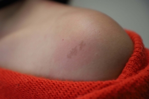 INVITA SSH A TENER ESPECIAL CUIDADO DE LA PIEL DURANTE &Eacute;POCA INVERNAL