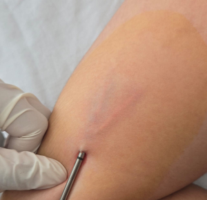 IMSS-Bienestar Hidalgo ampl&iacute;a el acceso gratuito a la salud reproductiva con jornada de colocaci&oacute;n de implante subd&eacute;rmico